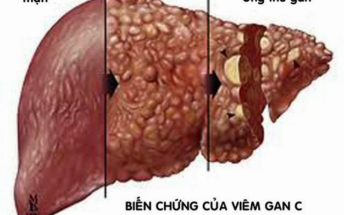 Việt Nam có 3 loại thuốc viêm gan C giá bằng 1% giá tại Mỹ