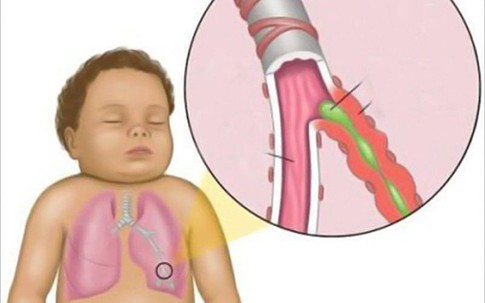Chuyên gia hướng dẫn cách đếm nhịp thở, cứu trẻ khỏi viêm phổi
