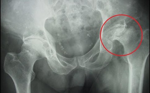Hoại tử chỏm xương đùi do uống rượu và hút thuốc lá