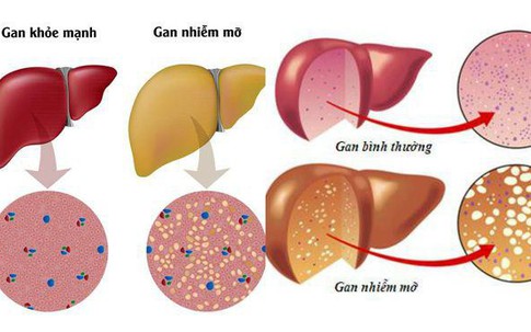 Không ăn chất béo, cô gái 23 tuổi vẫn bị gan nhiễm mỡ bởi lý do không ai ngờ tới