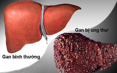 Ung thư gan dẫn đầu các ca bệnh ung thư tại Việt Nam