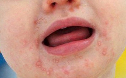 Con mắc tay chân miệng nặng thêm vì những sai lầm này của người lớn