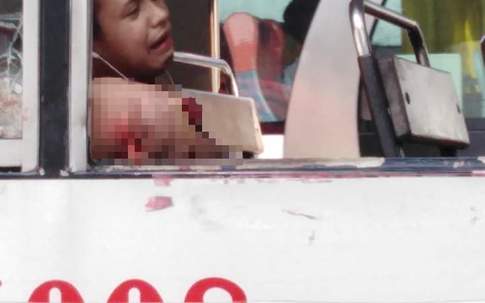 Thanh niên đau đớn mất cánh tay chỉ vì thói quen mà rất nhiều người mắc phải khi đi xe buýt