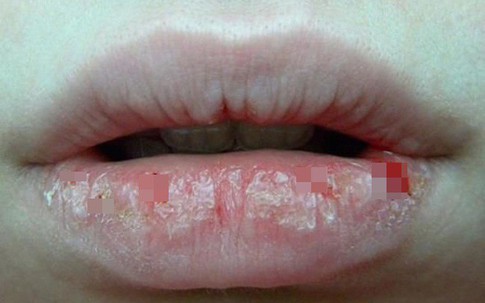 Môi bong, nứt nẻ đừng nghĩ do thời tiết, có thể là bệnh cực kỳ nguy hiểm