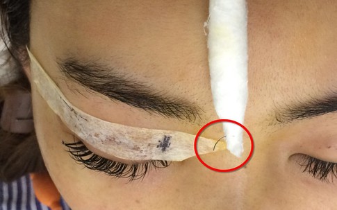 Vì sao tiêm chất làm đầy filler vào mũi lại gây mù mắt?