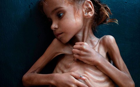 Bé gái da bọc xương gây chấn động thế giới về nạn đói ở Yemen qua đời