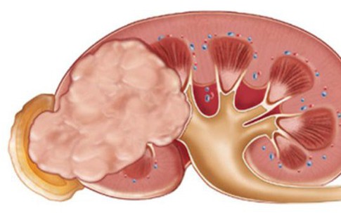 Những điều ít biết về căn bệnh ung thư thận diễn viên Ngọc Căn mắc phải