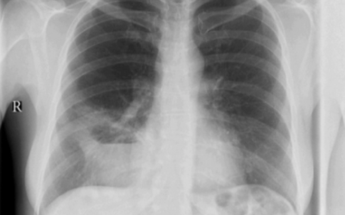 Ho, khạc kéo dài, nữ bệnh nhân bỗng phát hiện bất thường hiếm gặp ở phổi