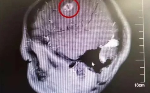 Bác sĩ lôi ký sinh trùng 15cm trong não bé trai, cảnh báo thói quen xấu khi ăn uống