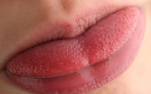 Màu sắc của lưỡi cảnh báo bệnh