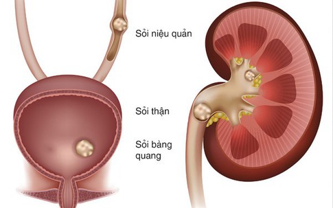 Mắc bệnh xốp thận cần lưu ý gì?