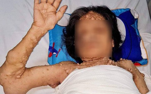 Giải cứu nữ bệnh nhân U70 hơn nửa cuộc đời sống cảnh "đại bàng gãy cánh"