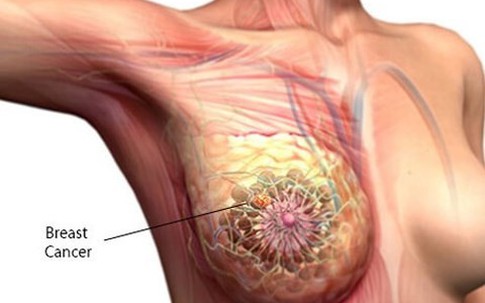 Người mẹ có hai con gái đều mắc bệnh ung thư vú