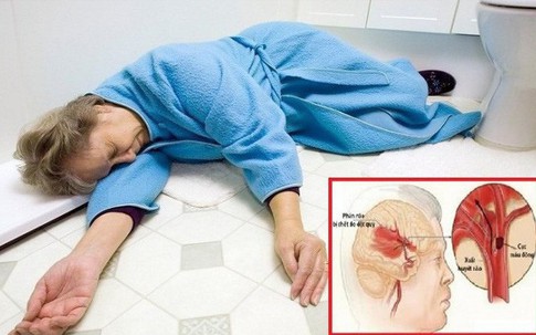 Những lưu ý “cơ hội vàng” để xử trí bệnh đột quỵ