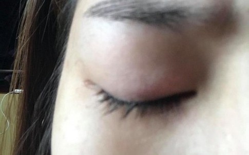 Hương Tràm bị viêm kết mạc sâu vì lạm dụng kính áp tròng