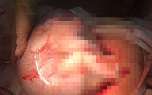 Hi hữu: Sản phụ sinh đôi có một bé gái còn nguyên trong túi ối