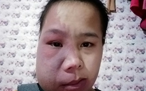 Niềm vui của cô gái có 10 năm đeo khối u khổng lồ trên mặt