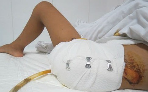 Chàng trai cắt chân khi bỏ bệnh viện về thầy lang chữa rắn cắn