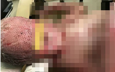 Cha lấy da đùi cứu con gái bị bỏng hơn 80% cơ thể