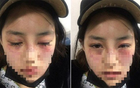 Cô gái Hàn Quốc bị bạn trai 19 tuổi đánh thừa sống thiếu chết