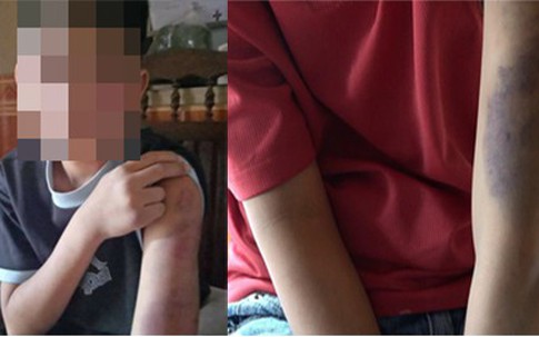 Bé trai bị bố và mẹ kế đánh bầm tím khắp người