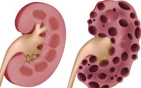 Suy thận rất nguy hiểm: Những dấu hiệu nhận biết bệnh mà ai cũng nên thuộc nằm lòng