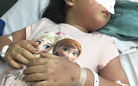 Cảnh báo: Bé gái 5 tuổi nổi mẩn khắp người sau khi uống trà sữa