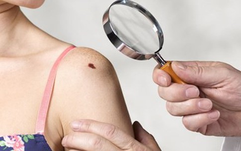 Cảnh báo ung thư từ những nốt ruồi lạ