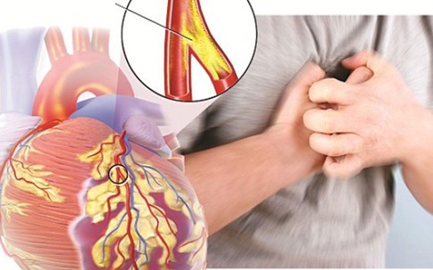 Béo phì – kẻ thù làm trái tim suy yếu