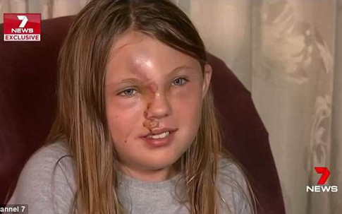 Con gái bất ngờ bị hủy hoại gương mặt sau tai nạn thảm khốc, mẹ tuyệt vọng chỉ biết làm cách này để cứu con
