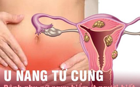 U nang tử cung - bệnh phụ nữ nguy hiểm chị em cần nắm rõ để chữa ngay còn kịp