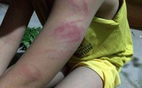 Giáo viên đánh thâm tím tay học sinh lớp 1: Chỉ phê bình có đủ răn đe?