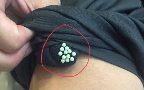 Cẩn trọng với "quái vật" đẻ trứng, hoành hành trong mùa hè gây bệnh viêm da, mù mắt, dễ nhầm lẫn với bệnh zona