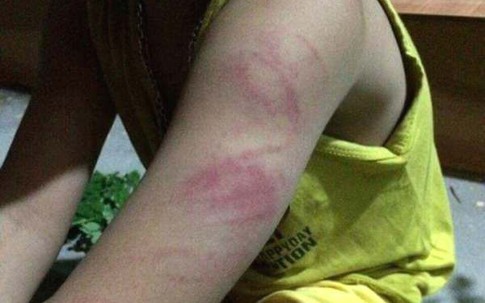 Nữ giáo viên cầm roi đánh bầm tím tay học sinh lớp 1 chỉ bị… phê bình, nhắc nhở