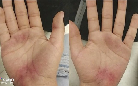 Con đi học về với đôi bàn tay trầy trụa, mẹ báo nhà trường và cảnh sát vào cuộc điều tra ngay lập tức