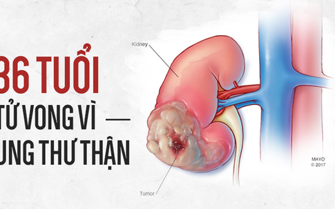 36 tuổi bị tử vong vì ung thư thận: Bác sĩ cảnh báo những thói quen bạn nên xem lại