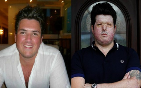 Hạnh phúc của người đàn ông từng bị tạt axit nhầm