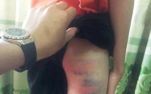 Nghệ An: Phòng GD&ĐT huyện Đô Lương nói gì về vụ cô giáo đánh con chồng nhập viện