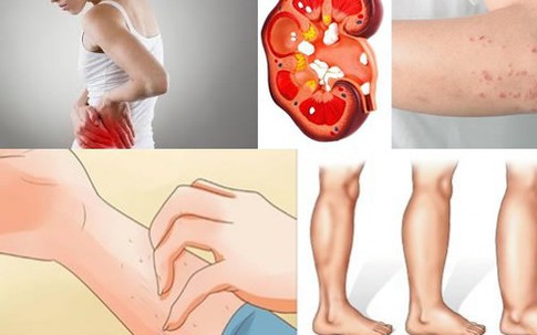 Tỉnh táo với 10 dấu hiệu không rõ ràng nhưng lại là tín hiệu cho thấy thận của bạn đang có vấn đề