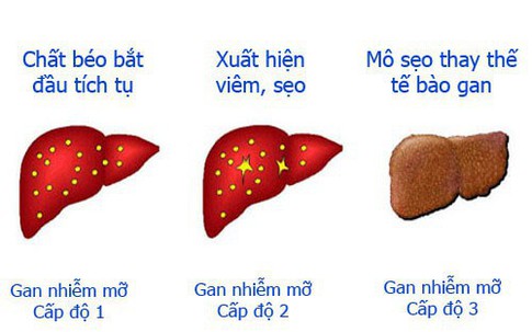 Top 4 nguyên nhân của bệnh gan nhiễm mỡ và những thực phẩm nên ăn để bảo vệ gan, phòng ngừa bệnh