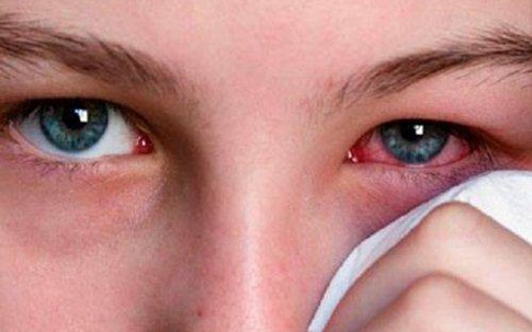 Mùa World Cup: Cẩn trọng với vết máu đỏ trong mắt khi xem bóng liên tục