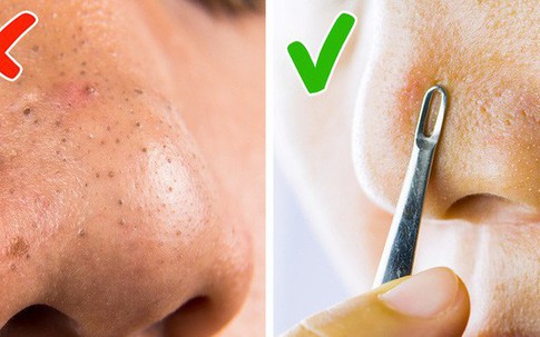 5 phương pháp chăm sóc da cực đơn giản mà chị em nên nhớ để tránh xa đám mụn đầu đen đáng ghét