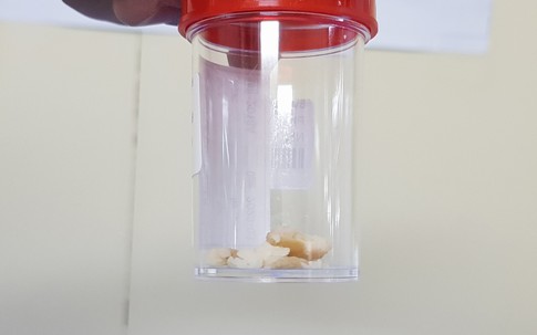 Cụ ông 87 tuổi suýt chết vì sặc hạt mít