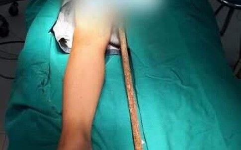 Thanh sắt dài 60cm đâm từ bộ phận sinh dục xuyên thẳng lên ổ bụng bé trai