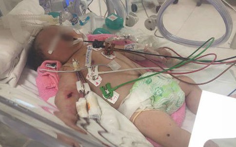 Lọc máu liên tục 2 ngày cứu bé sơ sinh bỏ bú, hôn mê