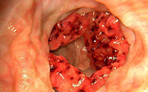 4 triệu người Việt mắc bệnh đại tràng: Thủ phạm có thể là món "ưa thích" trên mâm cơm