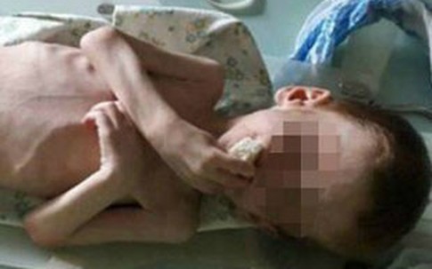 Bé 4 tuổi ở Ukraine nặng 7 kg vì bị bố mẹ bỏ đói