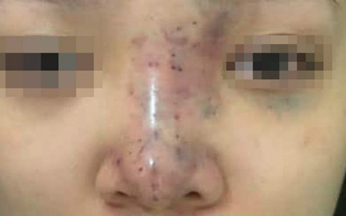 Chủ spa biến mất sau ca nâng mũi khiến cô gái 20 tuổi mù mắt