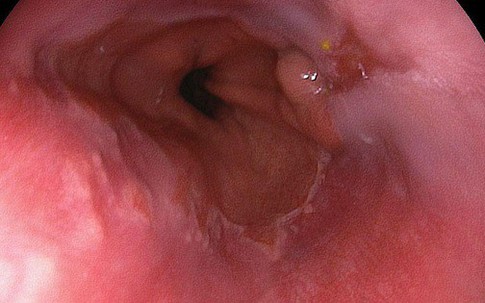 Chỉ cần thấy 1 trong 4 dấu hiệu này lặp lại 2 tuần, bạn nên đi khám ung thư thực quản gấp