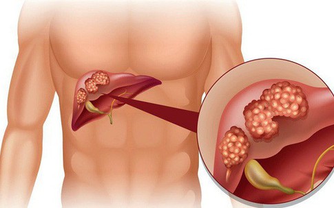 Nhiễm virus viêm gan B - nguy cơ mắc ung thư gan cao gấp 200 lần